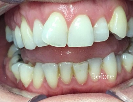 Before dental treatment at Ipswich Dental Surgery