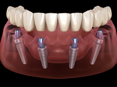 Smile in a day dental implants