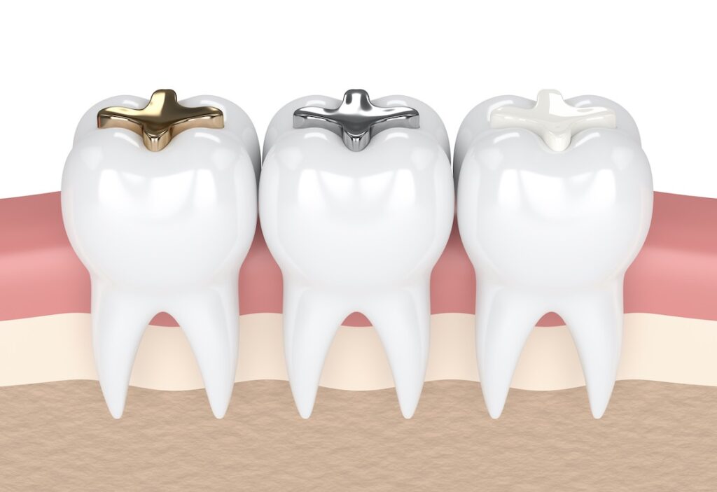Types of dental fillings
