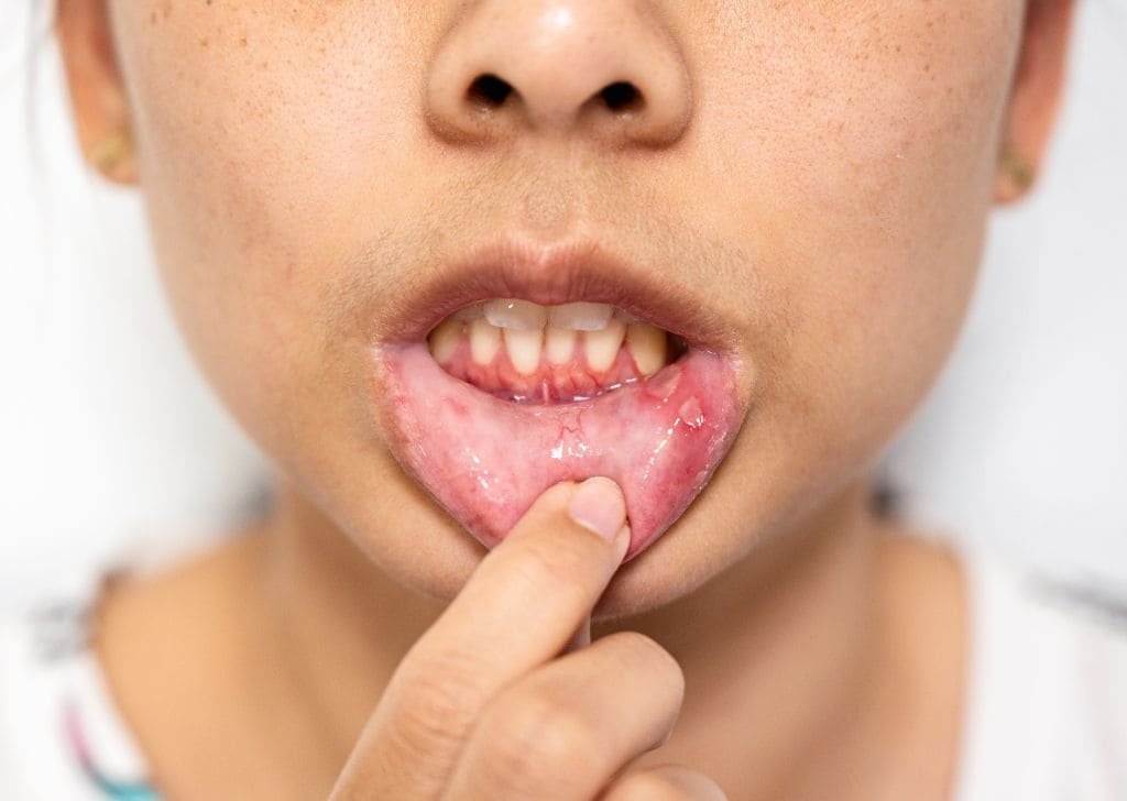 Woman getting dental abscess. This requires a visit at an emergency dentist in Ipswich.
