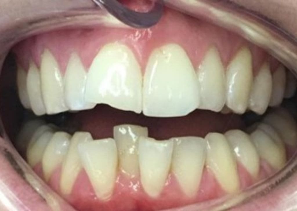 Invisalign Ipswich - Straighten Your Teeth Without Braces