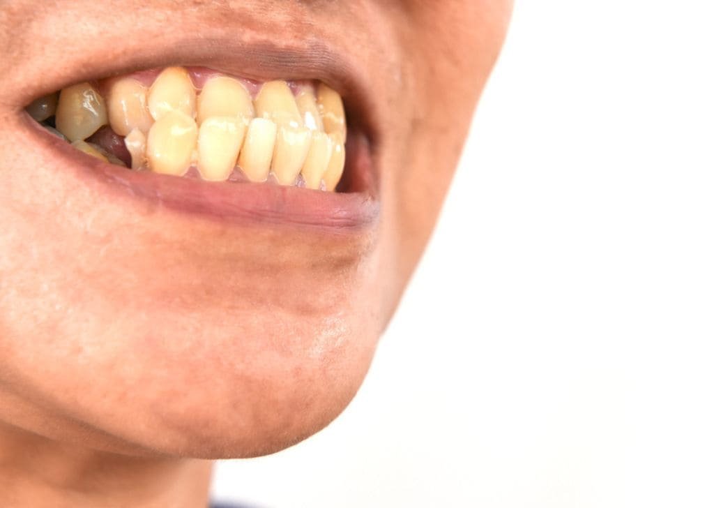 Invisalign Ipswich - Straighten Your Teeth Without Braces