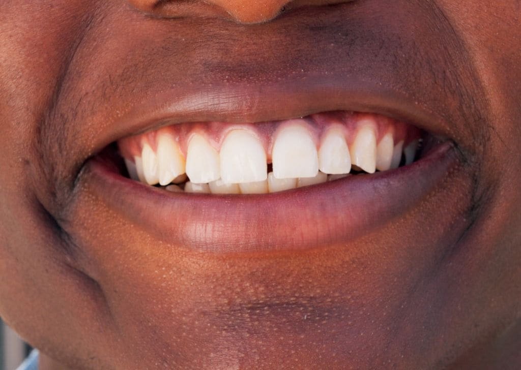 Invisalign Ipswich - Straighten Your Teeth Without Braces