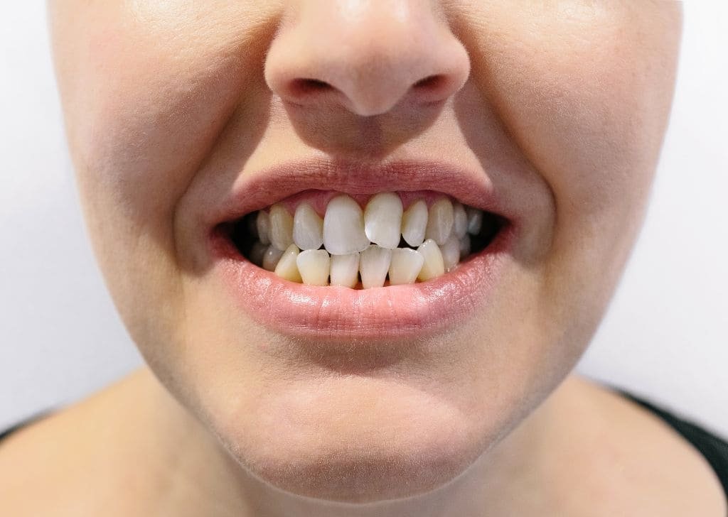 Invisalign Ipswich - Straighten Your Teeth Without Braces