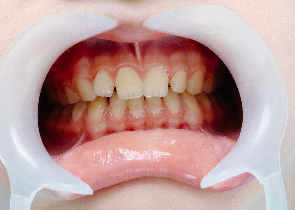 Invisalign Ipswich - Straighten Your Teeth Without Braces