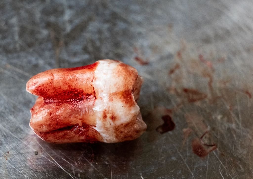 A knocked out tooth. An emergency at a dental clinic in Ipswich